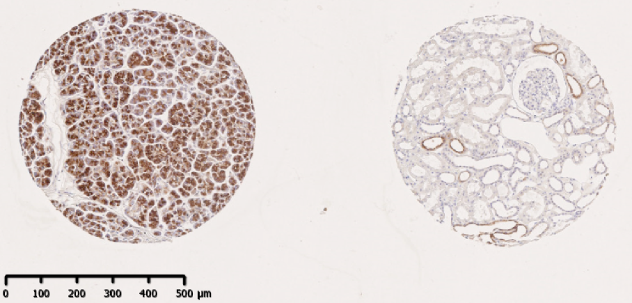 (left is pancreatic cancer and right is normal kidney